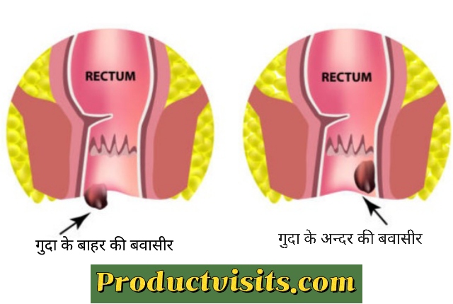 bawasir ke lakshan in hindi